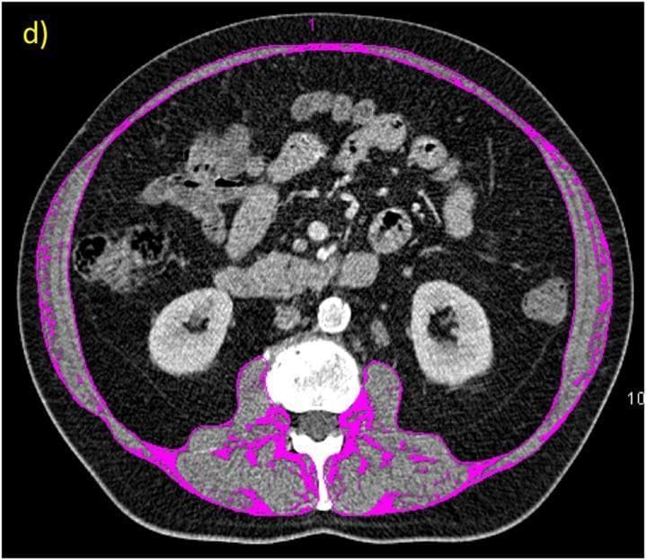 This diagnostic image is a transverse axial CT scan of the abdomen at the L3/L4 lumbar level, demonstrating densitometric quantification for body composition analysis. The image shows a cross-section of abdominal viscera, including the kidneys, intestines, and the lumbar spine. A specific region of interest (ROI) has been processed using thresholding (-190 to -30 Hounsfield Units) to identify adipose tissue. Areas highlighted in pink represent the Inter-Muscular Fat Area (IMFA) and subcutaneous adipose boundaries. These pink markings are visible within the posterior muscle compartments (including the erector spinae and psoas muscles) and along the inner fascia of the abdominal wall. This quantitative imaging technique is used in clinical research to assess muscle quality, myosteatosis, and overall metabolic health by isolating fat deposits within skeletal muscle groups, which are distinguished from lean muscle mass and visceral fat.