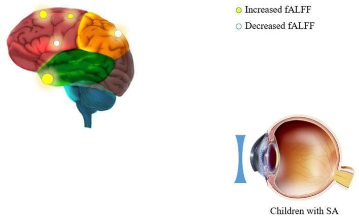 This composite educational graphic illustrates neurobiological and anatomical associations in children with strabismus amblyopia (SA). The upper-left portion features a lateral-view anatomical diagram of the human brain, color-coded by lobes: red (frontal), orange (parietal), and green (temporal). It overlays metabolic activity markers representing the fractional Amplitude of Low-Frequency Fluctuations (fALFF). Yellow circles indicate areas of increased fALFF (e.g., precentral gyrus, inferior parietal lobule), while white circles represent areas of decreased fALFF (e.g., superior frontal gyrus, temporal pole). The lower-right portion shows a sagittal cross-section of the human eye, detailing the cornea, iris, crystalline lens, and retina, with an external biconcave lens placed in front. This configuration demonstrates the clinical relationship between ocular structural correction and corresponding functional brain activity changes in pediatric patients with strabismus.