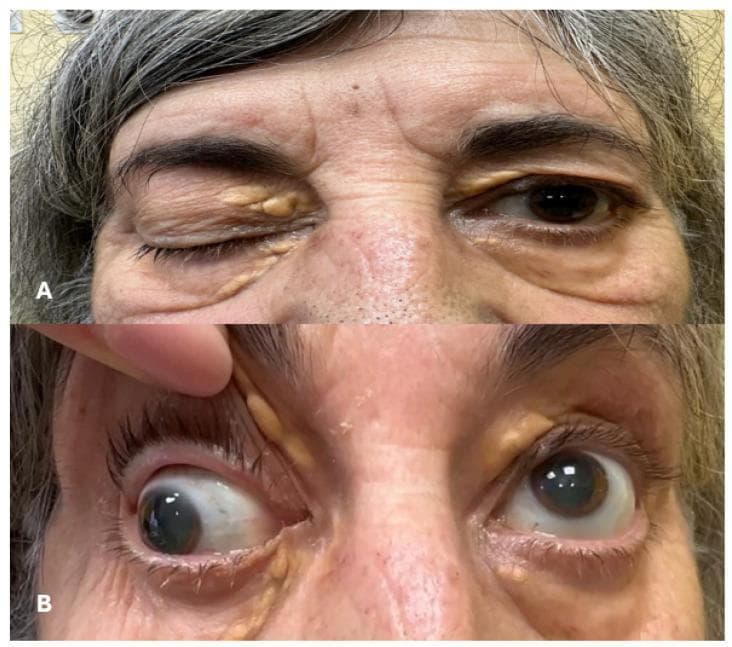 Clinical photograph of a patient's face in two panels (A and B) demonstrating right-sided oculomotor nerve (third cranial nerve) palsy and bilateral periorbital lesions. Image A shows complete ptosis of the right eye with the upper eyelid fully closed. In image B, with the right eyelid manually elevated, the right eye exhibits a 'down and out' primary position, indicative of unopposed action from the superior oblique and lateral rectus muscles. The right pupil is visibly dilated (mydriasis) compared to the left, and is clinically non-reactive or slow-reacting. Both eyes feature yellowish, flat, slightly elevated plaques on the upper and lower eyelids, characteristic of xanthelasma palpebrarum. The left eye serves as a control, showing normal primary gaze alignment and pupil size. These findings are presented in the context of oculomotor dysfunction potentially associated with ischemic events or systemic conditions like patent foramen ovale (PFO).