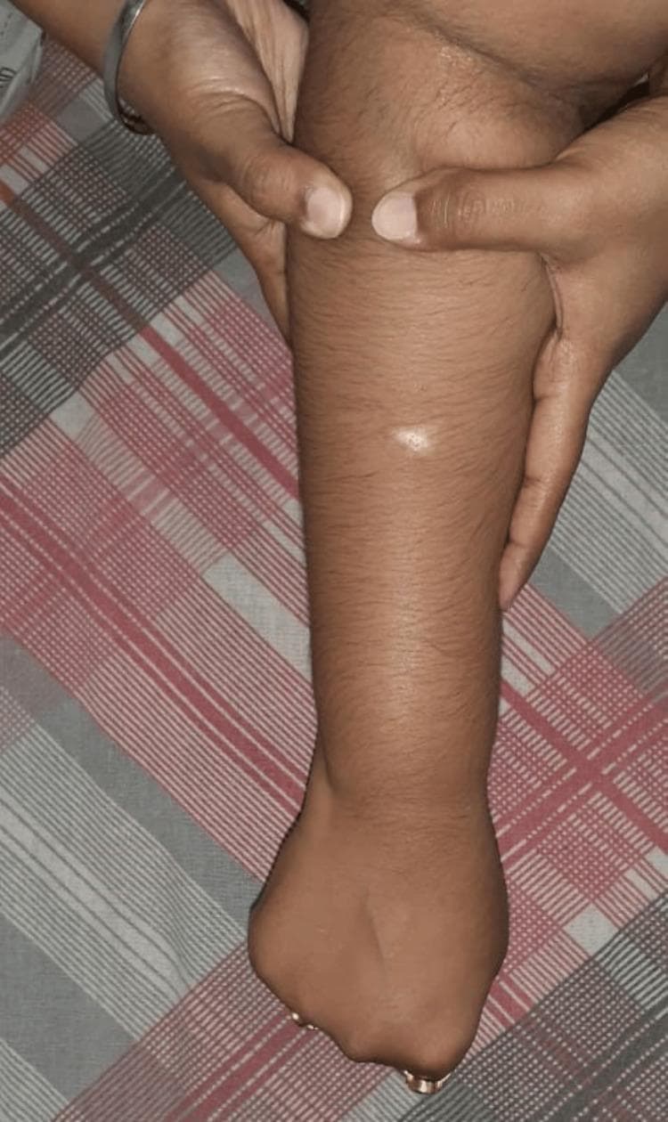 This clinical photograph demonstrates a soft tissue manual therapy intervention, specifically the Active Release Technique (ART), being applied to a patient's dorsal forearm. The image shows a practitioner's hands applying targeted manual pressure and longitudinal tension to the proximal forearm musculature. One hand is positioned near the elbow joint, while the other provides distal stabilization. A small, discrete, circular hypopigmented lesion or scar is visible on the mid-forearm's dorsal surface. The procedure is intended to address musculoskeletal dysfunction, such as adhesions or myofascial fibrosis resulting from repetitive strain or overload. The educational focus is on the clinical application of physiotherapy techniques for soft tissue mobilization and the visual presentation of skin landmarks during treatment.