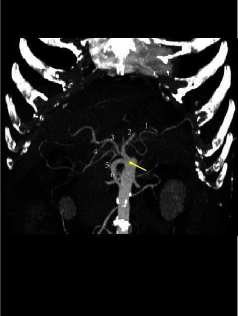 This diagnostic image is a 3D volume rendering CT scan illustrating a rare vascular anomaly known as a complete celiac-mesenteric trunk (CMT), indicated by a yellow arrow. The image demonstrates a single arterial trunk originating from the abdominal aorta, giving rise to both celiac and superior mesenteric arterial branches. Labeled anatomical structures include the splenic artery (1) coursing toward the left, the left gastric artery (2) ascending superiorly, and the common hepatic artery (3) extending toward the right, which further branches into the gastroduodenal artery (4). Mesenteric components are represented by the inferior pancreaticoduodenal artery (5) and superior mesenteric ramifications (6) descending inferiorly. This clinical imaging is essential for surgical planning and understanding congenital variations in abdominal arterial anatomy. The visualization uses high-contrast reconstruction to delineate the complex branching patterns and spatial relationships of the visceral vasculature relative to the vertebral column and ribs.