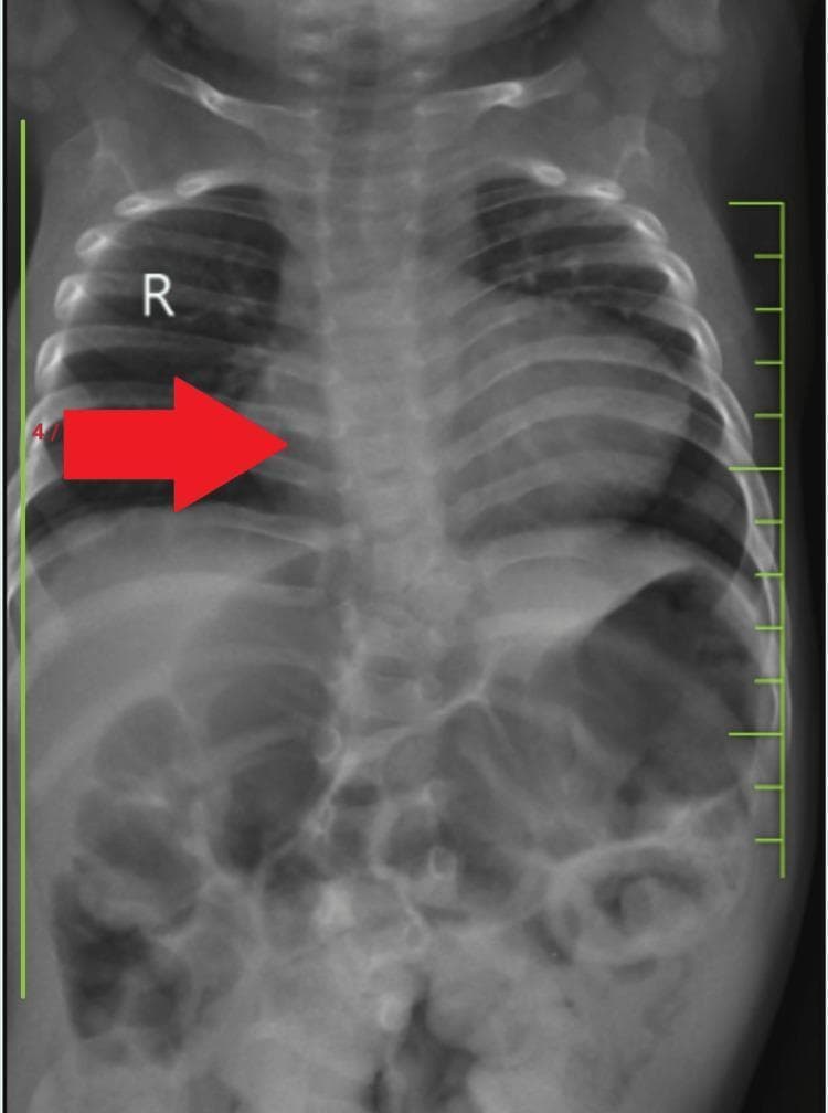 This diagnostic image is a posteroanterior (PA) chest X-ray of a pediatric patient demonstrating classic radiographic signs of Tetralogy of Fallot (TOF). The most prominent finding is a 'boot-shaped' heart (coeur en sabot), characterized by an upturned cardiac apex due to right ventricular hypertrophy and a concave pulmonary artery segment (pulmonary conus). The lung fields appear relatively oligemic, consistent with decreased pulmonary blood flow. The mediastinum is centrally located, and the diaphragm is well-defined, with the right hemidiaphragm slightly superior to the left. The skeletal structures show visible ribs and a vertebral column that appears to have mild alignment irregularities, potentially correlating with lumbar kyphoscoliosis mentioned in clinical context. The lower portion of the radiograph captures the upper abdomen, showing normal bowel gas patterns. This imaging is a classic educational example for pediatric cardiology and radiology, illustrating the morphological changes in the heart and great vessels associated with cyanotic congenital heart disease.