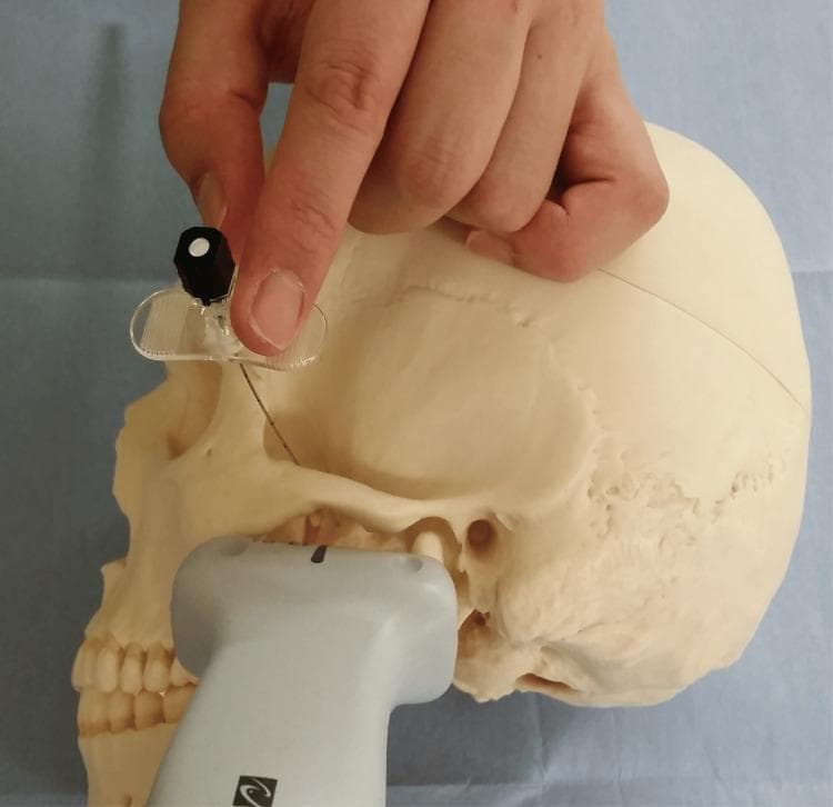 A clinical photograph demonstrating the procedural setup for an ultrasound-guided maxillary nerve block (UGMNB) using a supra-zygomatic approach on a skull model. A high-frequency linear ultrasound probe is positioned horizontally over the zygomatic arch and infratemporal fossa region to visualize deep anatomical landmarks, specifically the lateral pterygoid plate and the pterygopalatine fossa. A needle is shown entering through a clear, winged needle guide held by a hand. The needle trajectory is directed inferiorly and medially toward the target area posterior to the maxilla. This educational visual illustrates the spatial relationship between the ultrasound transducer, the needle insertion point, and the underlying osseous anatomy of the skull. This setup is used in regional anesthesia and pain management to provide sensory blockade for maxillofacial surgeries. The use of the needle guide ensures precise angle control and alignment with the ultrasound beam for real-time visualization of the needle tip.