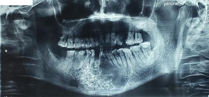 This orthopantomogram (panoramic X-ray) of the human mandible reveals a significant diagnostic finding in the right mandibular body extending toward the symphysis. The image displays a large, well-defined multilocular radiolucent lesion characterized by two distinct internal architectural patterns: a 'honeycomb' appearance, consisting of numerous small, uniform radiolucent compartments separated by thin radiopaque septa, and a 'soap bubble' pattern featuring larger, more irregular circular radiolucencies with thicker internal septations. The lesion demonstrates cortical expansion and involves a substantial portion of the vertical mandibular height, commonly associated with odontogenic tumors such as ameloblastoma or odontogenic keratocysts. The radiographic presentation is indicative of a slow-growing but locally aggressive intraosseous pathology. Educational focus includes the recognition of multilocular radiolucencies in oral and maxillofacial radiology and the differential diagnosis of mandibular cystic and neoplastic lesions based on internal trabeculation patterns.