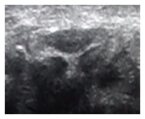 This diagnostic image is a musculoskeletal ultrasound (US) of the wrist in a transverse cross-section at the level of the carpal tunnel inlet. The primary focus is the median nerve, which appears as a centrally located, hypoechoic, oval structure. The nerve is demarcated by a distinct hyperechoic perineural rim. The surrounding carpal tunnel anatomy exhibits a heterogeneous echotexture, with deeper hyperechoic areas representing carpal bones and adjacent soft tissue structures. In this clinical context of moderate Carpal Tunnel Syndrome (CTS), the median nerve demonstrates edema and enlargement, with a cross-sectional area (CSA) of 14 mm². The image illustrates the use of high-frequency linear transducers in diagnosing nerve entrapment by assessing morphological changes, nerve flattening, and increased CSA compared to standard reference values. It serves as a key diagnostic example for physical medicine, rehabilitation, and radiology education regarding musculoskeletal ultrasonography.
