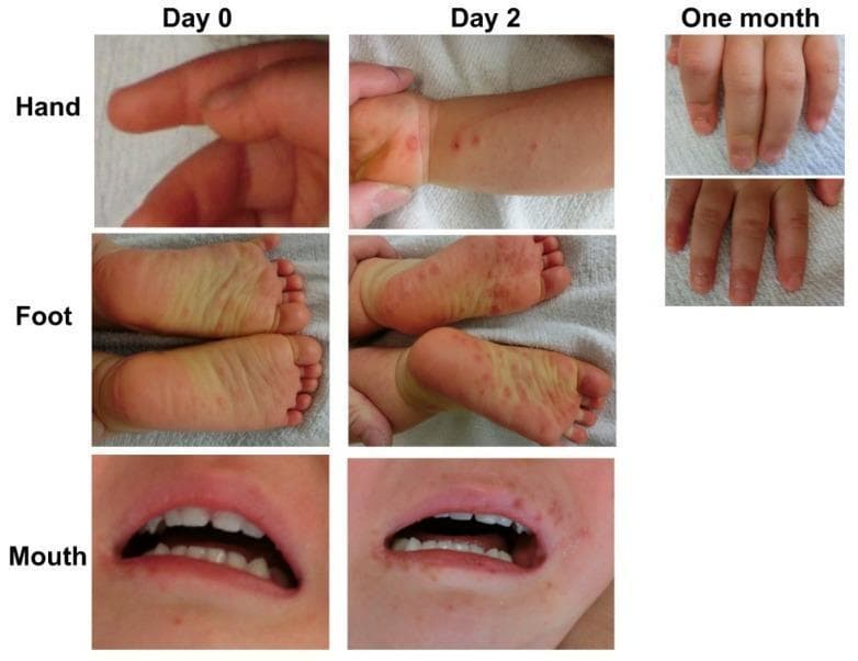 This clinical photographic montage illustrates the progression and sequelae of Hand, Foot, and Mouth Disease (HFMD) in a pediatric patient over a one-month period. The visual data is organized by anatomical site (hand, foot, and mouth) and time point (Day 0, Day 2, and one month). At Day 0, early manifestations include mild erythema and a few subtle red macules. By Day 2, the lesions progress into more distinct, numerous erythematous papules and vesicles: the hand shows clusters on the wrist and palm, the soles of the feet exhibit a widespread maculopapular rash, and the perioral and intraoral regions demonstrate pronounced papular eruptions and early ulceration. The far-right images document a late-stage complication at one month: while the primary rash has resolved, the fingernails show clear evidence of onycholysis (separation of the nail plate from the nail bed). This progression is characteristic of atypical HFMD caused by Coxsackievirus A6 (CV-A6), which is frequently associated with more extensive skin involvement and subsequent nail changes such as onychomadesis or onycholysis.