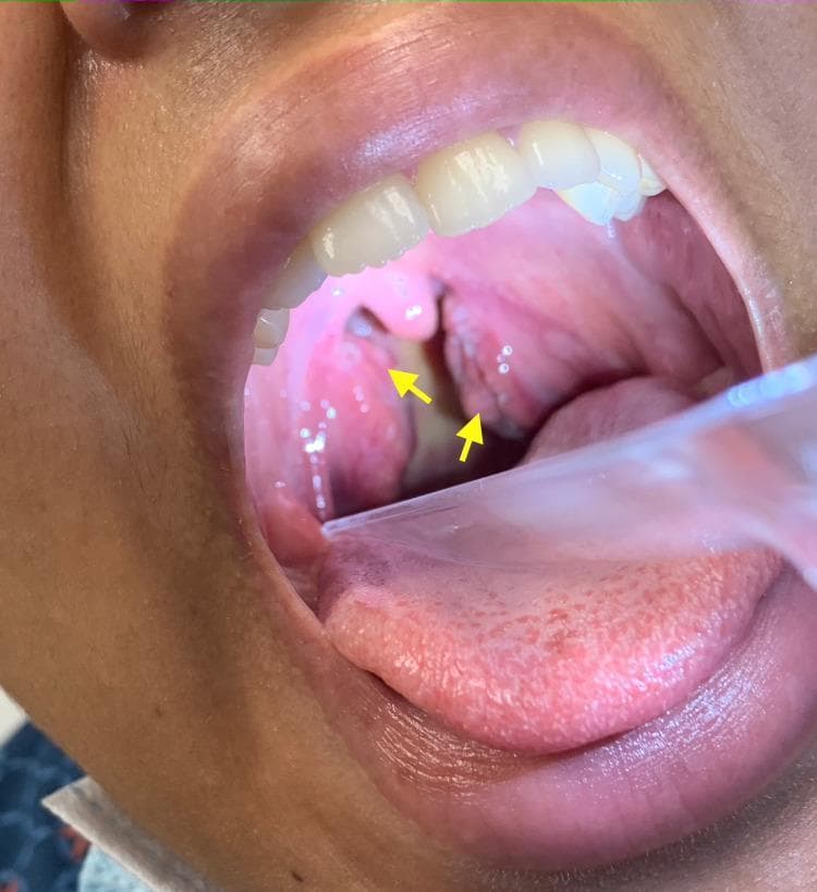 This clinical photograph displays an intraoral view of the oropharynx, captured using a clear plastic tongue depressor. The image shows significant bilateral tonsillar hypertrophy, with the palatine tonsils appearing erythematous and markedly enlarged, nearly meeting at the midline. Yellow arrows highlight the presence of white-to-grayish follicular exudates localized on the tonsillar surfaces. The surrounding pharyngeal mucosa exhibits diffuse erythema, consistent with an acute inflammatory process. These visual findings are classic clinical indicators of acute exudative tonsillitis, which can be seen in conditions such as streptococcal pharyngitis or infectious mononucleosis. The anatomical focus includes the soft palate, uvula, palatine tonsils, and the posterior pharyngeal wall, demonstrating typical signs of infectious oropharyngeal pathology.