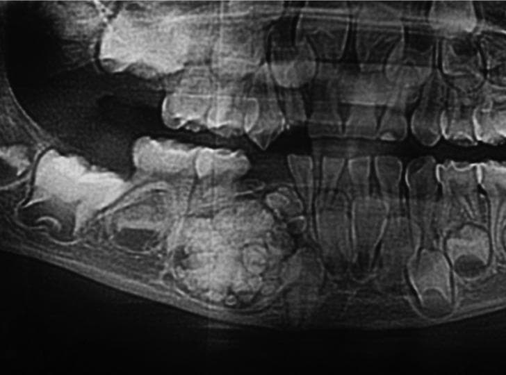 This diagnostic image is a cropped panoramic dental radiograph demonstrating a compound odontoma in the mandible. The lesion presents as a well-defined, heterogeneous radiopaque mass characterized by a cluster of multiple small, tooth-like structures (denticles) of varying sizes and shapes. These denticles exhibit radiodensity similar to natural enamel and dentin. The odontoma is encased in a thin radiolucent rim or halo, which separates it from the adjacent trabecular bone. Clinical significance is illustrated by the lesion's mass effect, which has caused the displacement and impaction of neighboring permanent teeth, interfering with their normal eruptive pathway. There is evidence of mild cortical bone thinning and localized bone remodeling at the periphery of the lesion. This radiographic finding is a hallmark of benign odontogenic tumors, specifically compound odontomas, typically found in the anterior maxilla or posterior mandible. The image is an essential educational resource for oral and maxillofacial radiology, highlighting the characteristic 'bag of teeth' appearance used to differentiate it from complex odontomas.