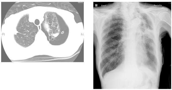 The image consists of two clinical imaging panels. The left panel is an axial chest CT scan showing extensive emphysematous changes and large bullae in the left lung, accompanied by a significant left-sided pneumothorax and a visible chest tube (thoracostomy). The right lung shows relatively normal parenchymal markings. The right panel is a posterior-anterior (PA) erect chest X-ray taken post-endobronchial valve (EBV) insertion. It demonstrates incomplete re-expansion of the left lung with persistent opacity and volume loss in the upper lobe, while the right lung remains clear. This comparison illustrates the management of a persistent air leak in a patient with severe emphysema using EBVs to occlude bronchopulmonary segments. Key features include the diagnostic visualization of bullous disease, the management of secondary spontaneous pneumothorax, and the follow-up of bronchoscopic lung volume reduction or air leak control procedures.