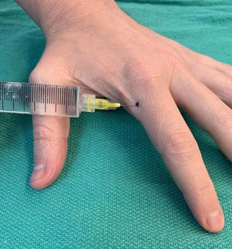 A procedural clinical photograph demonstrating a subcutaneous injection technique on the left hand. The dorsal view shows a hand resting on a green surgical drape. A clear plastic syringe, containing a translucent liquid and graduated volumetric markings, is oriented horizontally. It is fitted with a 30-gauge needle on a yellow hub, which is inserted into the radial side of the second digit (index finger). The injection site is located approximately 1 cm distal to the metacarpophalangeal joint, marked by a small dark ink dot at the junction of the palmar and dorsal skin. This specific placement is used for botulinum toxin administration in the treatment of Raynaud's phenomenon or digital ischemia, targeting the vicinity of the digital arteries while minimizing diffusion to the intrinsic thenar muscles. The syringe and hand positioning illustrate the proper angle and anatomical landmarks for targeted digital neurovascular bundle injections.