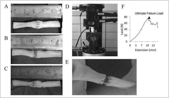 A multi-panel educational figure demonstrating biomechanical testing of porcine tendon repair techniques. Panels A-C provide close-up clinical photographs of three specific suture configurations: (A) Modified Kessler (MK) showing a classic boxed core suture with peritendinous reinforcement, (B) Interlock Suture (IS) exhibiting a continuous interlocking pattern for increased grip, and (C) Modified Kessler-Loop Lock (MKL) featuring boxed sutures with additional locking loops. Panel D displays the experimental setup with a repaired tendon secured vertically between the pneumatic grips of a mechanical testing machine (Instron model). Panel E shows the clinical manifestation of mechanical failure, characterized by a visible 2-mm gap formation and fraying of tendon fibers at the repair site under tension. Panel F is a line graph illustrating a typical load-deformation curve, plotting tensile Load (N) against Extension (mm), with a designated triangle marking the 'Ultimate Failure Load' at approximately 75N. This figure is used in orthopedic research and surgical training to compare the tensile strength and failure modes of different flexor tendon repair strategies.
