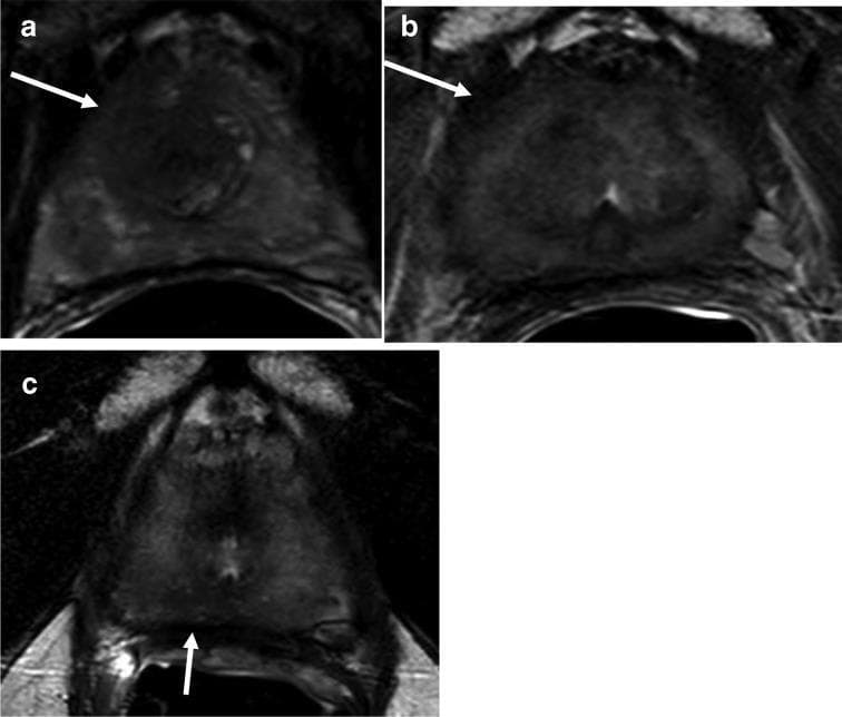 Diagnostic axial T2-weighted (T2W) MRI of the prostate showing a progression from pre-treatment to post-treatment and biochemical recurrence. Image A demonstrates an ill-defined, heterogeneous hypointense lesion in the right apical-mid anterior peripheral and transition zones (indicated by arrow), consistent with primary prostate cancer. Image B shows the prostate after treatment, exhibiting a diffuse iso-to-hypointense signal pattern characteristic of radiation therapy or systemic treatment effects, with the original lesion no longer discernible. Image C illustrates the gland at the time of biochemical recurrence; while it retains the diffuse treatment-related signal changes, a new focal hypointense lesion is identified in the midline to right apical peripheral zone (indicated by arrow). This focal area of signal loss is highly suspicious for recurrent prostate adenocarcinoma. The series serves as an educational example of monitoring treatment response and detecting localized recurrence using MRI in the context of rising PSA levels.