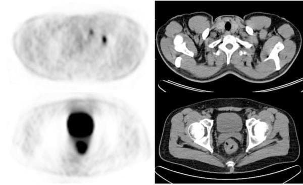 This diagnostic image set consists of paired axial PET and CT scans demonstrating metastatic colorectal cancer. The top row displays the neck region, where the PET scan reveals focal areas of increased metabolic activity (hypermetabolism) in the left supraclavicular region, anatomically correlating with supraclavicular lymph node metastasis on the adjacent CT. The bottom row shows the pelvic region, with the PET scan highlighting a prominent area of intense FDG uptake in the rectum, identifying the primary tumor site. The corresponding axial CT scan provides anatomical localization within the pelvis, showing the rectum, bladder, and iliac structures. These images illustrate the clinical utility of PET/CT in oncology for systemic staging, specifically identifying distant nodal metastases that may alter surgical and chemotherapeutic management strategies for rectal cancer. Key educational concepts include PET/CT fusion for oncologic staging, metabolic characterization of primary tumors, and the identification of regional versus distant lymphadenopathy.