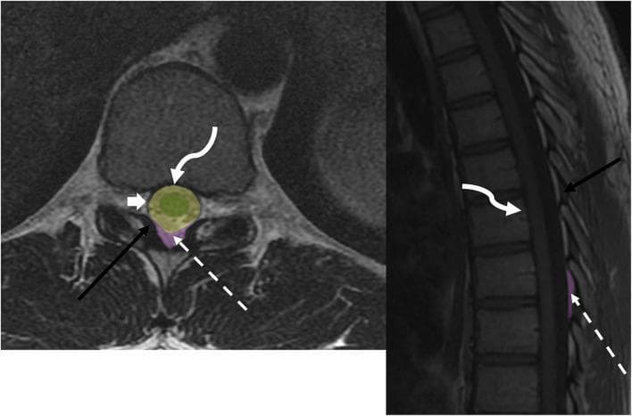 This educational anatomical diagram utilizes MRI sequences to illustrate the compartmental anatomy of the spinal canal. On the left, an axial T2-weighted image shows a cross-section of a lumbar vertebra, highlighting the high-signal (bright) cerebrospinal fluid within the thecal sac (broad white arrow). On the right, a sagittal T1-weighted sequence displays the vertical alignment of vertebral bodies and the spinal cord. Color-coded overlays define three key anatomical spaces: the intramedullary space (green) containing the spinal cord, the intradural space (yellow), and the dorsal epidural space (purple). Key ligamentous landmarks are annotated with arrows: the posterior longitudinal ligament (curved white arrow) bordering the anterior aspect of the canal, and the ligamentum flavum (black arrow) forming the posterior border. The dotted white arrow points to the epidural fat within the epidural space, characterized by intermediate signal on T1 and T2 sequences. This visualization is designed for teaching clinicians and medical students the spatial relationships necessary for localizing spinal pathologies such as disc herniations, epidural abscesses, or intramedullary tumors.