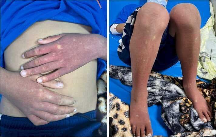 This clinical photograph displays a pediatric patient with a classic dermatological presentation of the recovery phase of Dengue Fever. Two side-by-side images show the dorsal surfaces of the hands, forearms, lower legs, and feet. The primary finding is a diffuse, confluent, erythematous rash covering the extremities. This background erythema is punctuated by multiple small, irregular macules and patches of pale, normal-appearing skin. This characteristic morphological pattern is classically described in clinical medicine as 'white islands in a sea of red.' The distribution is symmetric across the upper and lower limbs. Clinically, this convalescent rash typically appears after the defervescence of fever in dengue virus infection and is a key diagnostic physical sign indicating the recovery phase of the disease. The image is a valuable educational resource for infectious disease and pediatric dermatology, illustrating the morphological distinction between confluent erythematous lesions and spared areas of skin.
