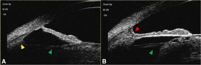Educational ultrasound biomicroscopy (UBM) images (Figures A and B) of the right eye anterior segment, demonstrating congenital megalophthalmos and cataract. The images show a deep anterior chamber with an open iridocorneal angle. Key findings include:
1. Lens: An opacified, cataractous lens is visible as an echogenic structure.
2. Suspensory Ligaments: Prominent, elongated zonular fibers (green arrowheads) connect the lens equator to the ciliary body, a hallmark of anterior segment enlargement.
3. Ciliary Processes: Small, hyperechoic ciliary processes (yellow arrowhead in Fig A) are visualized posterior to the iris.
4. Pectinate Ligament: A distinct pectinate ligament (red arrowhead in Fig B) is noted at the anterior chamber angle, appearing as a bridge of tissue spanning the angle recess.
This diagnostic imaging illustrates the structural abnormalities associated with congenital ocular enlargement, specifically focusing on the anatomical relationship between the lens, zonules, and ciliary body, and is intended for ophthalmology residents and specialists studying lens subluxation risk or glaucoma in megalophthalmos.