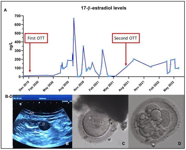 A composite medical illustration and imaging panel documenting ovarian function follow-up and in vitro fertilization (IVF) outcomes. Panel A is a line graph depicting 17-̢-estradiol levels (ng/L) over a two-year timeline, marking two separate ovarian tissue transplantation (OTT) events. Panel B is a transabdominal ultrasound image showing the abdominal wall (AW) and a hypoechoic follicle containing an oocyte (O) during a pick-up procedure. Panels C and D are microscopic diagnostic images of embryonic development. Panel C shows a Day 1 fertilized oocyte featuring two distinct pronuclei (*) and two extruded polar bodies (#) within the zona pellucida (ZP). Panel D demonstrates a Day 3 dividing embryo at the 6-cell stage, showing multiple blastomeres enclosed by the zona pellucida (ZP). This sequence illustrates the progression from clinical monitoring of hormone levels and follicle development to cellular-level fertilization and cleavage, relevant for reproductive endocrinology and infertility (REI) education.
