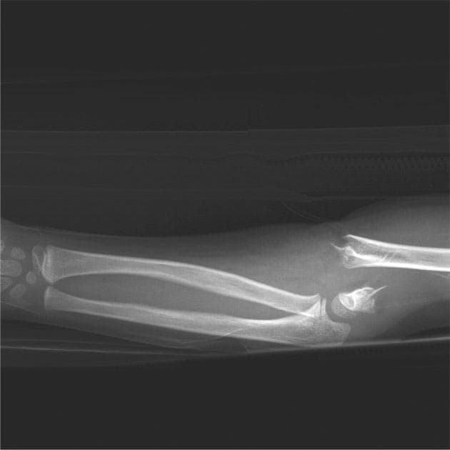This lateral view X-ray of a pediatric upper extremity demonstrates a severe supracondylar fracture of the distal humerus, classified as a Gartland Type III injury. The radiographic findings show a complete, multi-fragmentary disruption of the humeral shaft just proximal to the epicondyles. There is significant posterior and superior displacement of the distal humeral epiphysis and the articulating forearm bones (radius and ulna) relative to the proximal humeral shaft. The anterior humeral line does not intersect the capitellum, indicating significant extension-type angulation. While the distal forearm appears grossly intact with preserved alignment between the radius, ulna, and proximal carpals, the elbow joint shows total loss of anatomical congruity. This clinical image is representative of high-energy pediatric trauma and is of high educational value for orthopedic classification and assessing associated neurovascular risks, such as brachial artery injury or compartment syndrome.