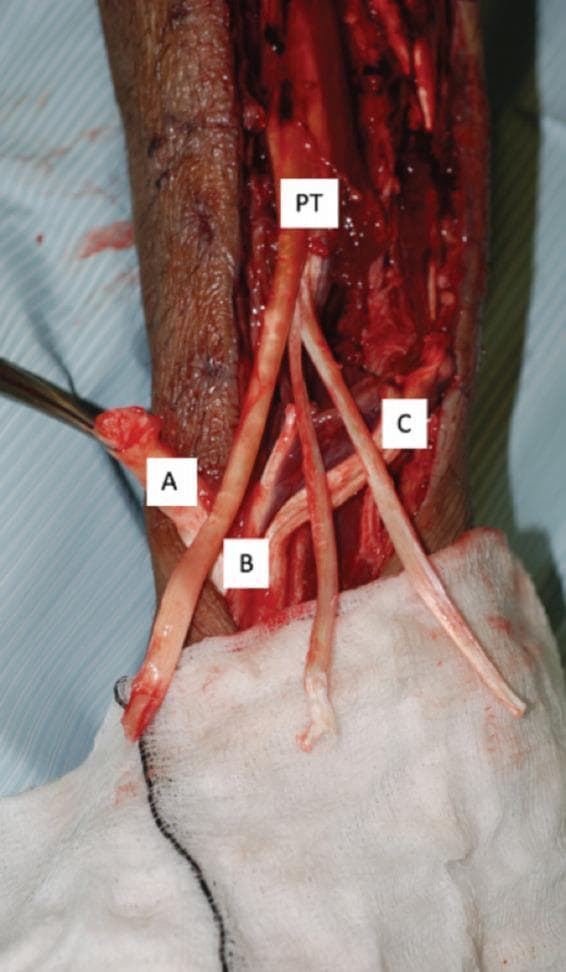 This clinical photograph shows an intra-operative view of a tendon transfer procedure in the lower extremity, likely following compartment syndrome or traumatic muscle loss. The image captures the dissection of key anatomical structures labeled for educational purposes. A thick Tibialis Posterior (PT) tendon is prominently displayed, split distally into three separate strands for transfer. Other identified tendons include the Tibialis Anterior (A), Extensor Hallucis Longus (B), and Extensor Digitorum Longus (C). These tendons appear as glistening, off-white, fibrous cords against a backdrop of deep red muscle tissue and a bloody surgical field. The surgical environment is characterized by the presence of metallic retractors, blue sterile drapes, and white gauze. This visual demonstrates the surgical approach to correcting foot drop or flexible deformities by utilizing the tibialis posterior as a motor unit to restore dorsiflexion. It is a critical resource for orthopedic and reconstructive surgery education regarding tendon harvesting and repositioning techniques.