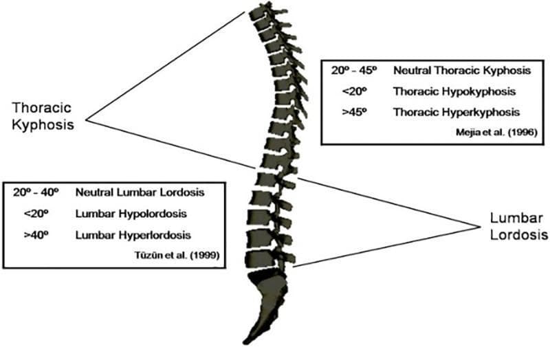 This anatomical diagram illustrates the sagittal classification of spinal curvature in a standing position, focusing on the thoracic and lumbar regions. A lateral view of the human vertebral column highlights two primary curvatures: Thoracic Kyphosis and Lumbar Lordosis. The diagram provides quantitative diagnostic criteria for each region based on established medical literature. For Thoracic Kyphosis (Mejia et al., 1996), values of 20°-45° are defined as neutral, <20° as hypokyphosis, and >45° as hyperkyphosis. For Lumbar Lordosis (Tüzün et al., 1999), the range of 20°-40° is classified as neutral, <20° as hypolordosis, and >40° as hyperlordosis. This infographic serves as a clinical reference for orthopedic and physiotherapeutic assessment of sagittal spinal alignment and postural deviations.
