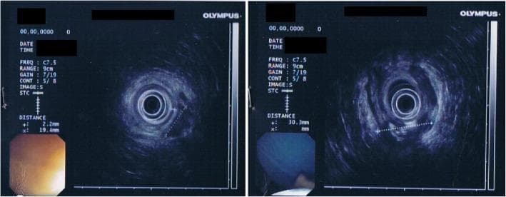 This diagnostic image displays two panels of transrectal endoscopic ultrasonography (TRUS) alongside corresponding endoscopic views. The TRUS images provide a cross-sectional view of the perianal and rectal anatomy. Key features include the internal anal sphincter (IAS), which is visualized as a continuous circular band with a measured thickness of approximately 2.2 mm. In the right posterior-lateral quadrant, a well-defined pathological lesion measuring approximately 30 mm x 15 mm is evident. This structure is predominantly hypoechoic, indicating fluid or soft tissue, and contains internal hyperechoic foci suggestive of gas bubbles—features characteristic of a perianal abscess with gas-forming components. The adjacent rectal mucosa appears normal in the integrated endoscopic inset. This imaging is clinically significant for evaluating the depth, extent, and specific echogenic characteristics of perianal inflammatory conditions or abscesses relative to the sphincteric complex.