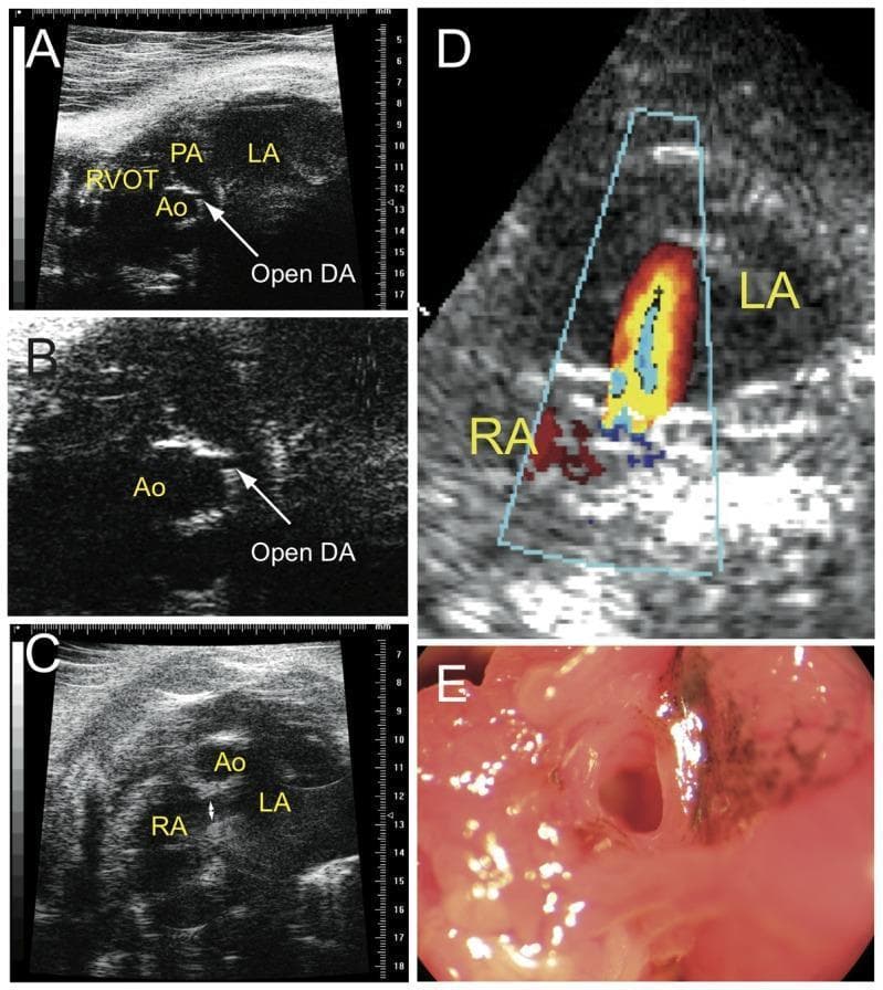 A multi-panel medical diagnostic and clinical series demonstrating congenital cardiovascular anomalies in a ctnnb1Δex3 model. Panels A and B are ultrasound images illustrating a Patent Ductus Arteriosus (PDA), with labels identifying the Left Atrium (LA), Aorta (Ao), Right Ventricle Outflow Tract (RVOT), and Pulmonary Artery (PA). An arrow points to the 'Open DA' (Ductus Arteriosus). Panel C provides an ultrasound view of the atrial septum with labels for the Right Atrium (RA), LA, and Ao, showing a patent foramen ovale. Panel D utilizes Color Doppler imaging to show a pathological right-to-left shunt of blood flow through the foramen ovale. Panel E is a clinical photograph of a dissected heart confirming the presence of an open foramen ovale, notable for the presence of dark pigmented cells (melanocytes) around the aperture. The collection demonstrates how failure of fetal cardiovascular shunts to close postnatally leads to abnormal circulation and chamber dilation.