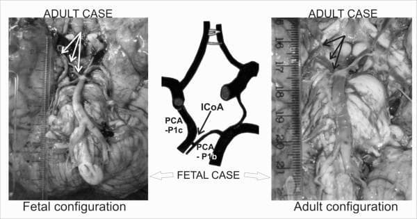This composite educational resource compares anatomical configurations of the Circle of Willis (CoW) in fetal and adult cadaveric specimens. The image consists of two clinical photographs of brain base specimens and a central schematic diagram focusing on the posterior segment of the cerebral arterial circle.
The 'Fetal configuration' (left) shows the ventral brainstem and diencephalon with visible vasculature. The accompanying central schematic labels the pre-communicating part of the carotid origin (PCA-P1c) and the pre-communicating part of the basilar origin (PCA-P1b), connected by an 'intermediate communicating artery' (ICoA). This configuration highlights an accessory vascular bridge within the P1 segment of the posterior cerebral artery.
The 'Adult configuration' (right) illustrates a more mature vascular pattern with larger calibres and increased tortuosity. Arrows point to the bifurcation sites and anatomical segments. The comparison focuses on the morphological evolution and persistence of the ICoA, which can influence the hemodynamics of the posterior circulation. This material serves as a reference for anatomical variations in neurovascular anatomy and surgical planning.