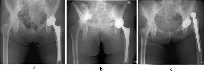 This series of three anteroposterior (AP) pelvic radiographs demonstrates the impact of pelvic tilt and posture on total hip arthroplasty (THA) component orientation in a 64-year-old female. Image (a) shows the pelvis in a supine position, with the left THA acetabular cup displaying an inclination of 45° and anteversion of 25°. Image (b) shows the same patient in a standing position, where a marked posterior (backward) pelvic tilt is visible, causing a secondary increase in cup inclination to 59° and anteversion to 42°. This demonstrates the dynamic relationship between spinal-pelvic alignment and prosthetic orientation. Image (c) provides a clinical complication example: a post-THA radiograph showing an anterior dislocation of the left hip prosthesis, where the femoral head component is completely displaced from the acetabular cup. These images serve as educational material for orthopedic surgery, specifically focusing on preoperative planning, the effects of sagittal pelvic mobility on implant stability, and postoperative complication monitoring.