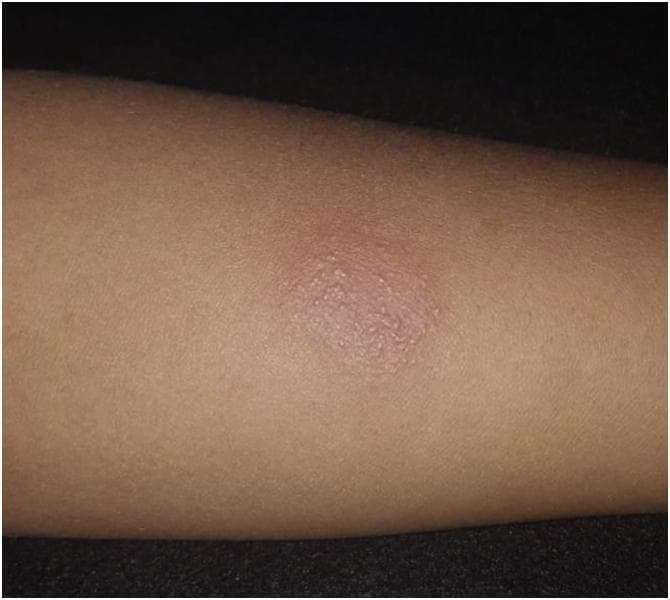 This clinical photograph displays a positive Tuberculin Skin Test (Mantoux test) on the forearm of a patient. The image shows a well-defined, raised erythematous plaque characterizing a strongly reactive 19 mm PPD (purified protein derivative) result. The lesion is primarily a reddish-pink circular area of induration, exhibiting a slightly bumpy, textured surface with fine papular elevations. The surrounding skin shows mild peripheral erythema that fades into the normal skin tone. This visual represents a delayed-type hypersensitivity reaction (Type IV), indicative of current or past infection with Mycobacterium tuberculosis. The educational focus is on the clinical assessment of induration rather than just erythema to determine a positive diagnostic result in tuberculosis screening.