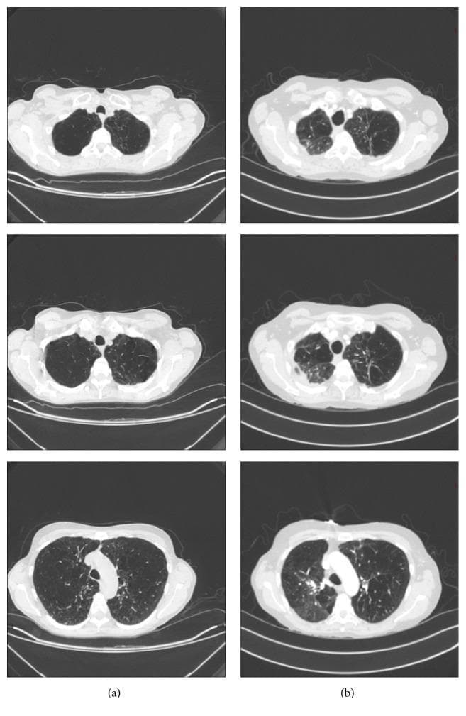 This Comparison Chart displays axial Computed Tomography (CT) scans of the chest across three different anatomical levels, comparing a baseline state (a) with a follow-up state (b). The baseline images (a) demonstrate bilateral, diffuse emphysema characterized by extensive areas of low attenuation and lung hyperinflation. In contrast, the follow-up images (b) show significant morphological changes, most notably prominent apical scarring and fibrotic changes predominantly localized to the right lung. There is visible right apical pleural thickening and a noticeable reduction in overall lung volume compared to the baseline, which previously showed flattened diaphragms and hyperexpansion. These diagnostic images illustrate the evolution from generalized obstructive lung disease to localized post-inflammatory or post-infectious fibrosis, highlighting changes in lung parenchyma and pleural space. This material is suitable for advanced medical education in pulmonology and radiology, focusing on the visual identification of emphysema versus fibrotic scarring and the assessment of lung volume changes on serial imaging.