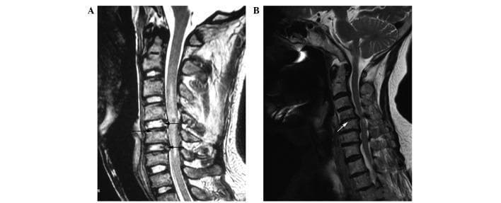 This diagnostic image consists of two sagittal T2-weighted magnetic resonance imaging (MRI) scans of the cervical spine, demonstrating a comparison between traumatic injury and degenerative disease. Panel A shows a control patient with cervical vertebrae fractures and dislocation at the C4 and C5 levels; however, the intervertebral discs at C4-5 and C5-6 maintain high T2 signal intensity, indicating healthy, non-degenerated nuclei pulposi. Black arrows point toward the experimental harvest sites. Panel B displays the cervical spondylosis group, characterized by multilevel disc herniation and significant signal loss (darkening) at the C4-5, C5-6, and C6-7 levels, which is diagnostic of advanced intervertebral disc degeneration (Thompson grades 3-5). A white arrow highlights a subtotal vertebrectomy site. The image illustrates the contrast between acute mechanical trauma (fracture/dislocation) with preserved disc integrity versus the progressive pathological changes of cervical spondylosis, including canal stenosis and decreased disc height.