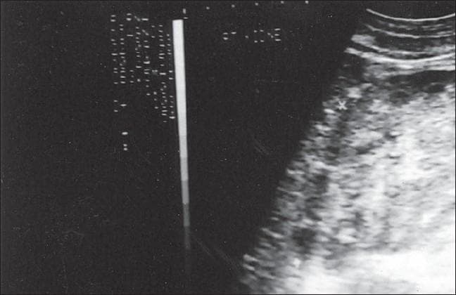 This diagnostic ultrasound image of the abdomen captures a kidney in longitudinal or sagittal view, demonstrating hallmark features of medical renal disease. The kidney is notably enlarged with a significant increase in parenchymal echogenicity (hyperechoic appearance). There is a distinct loss of normal corticomedullary differentiation, where the boundary between the renal cortex and the medullary pyramids is blurred and difficult to resolve. Such findings are characteristic of chronic renal pathologies, including renal amyloidosis or advanced parenchymal disease. The image includes standard sonographic markers, such as a vertical echogenicity scale on the left and subtle anatomical indicators of adjacent soft tissue at the superior aspect. This visual serves as an educational example for radiology and nephrology students to recognize ultrasonographic patterns of diffuse renal parenchymal injury and altered echotexture.