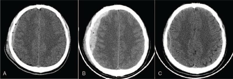 This comparison chart consists of three axial non-contrast computed tomography (CT) scans of the brain, labeled A, B, and C, illustrating the progression and resolution of an acute epidural hematoma (EDH) in the right frontal region. Scan A shows an initial, relatively thin hyperdense (bright) biconvex collection along the inner table of the right frontal skull, consistent with an acute EDH. Scan B demonstrates a significant interval increase in the volume and thickness of the hyperdense collection, which now exerts more pronounced mass effect on the underlying right frontal lobe parenchyma. Scan C is a follow-up image obtained after arterial embolization, showing a dramatic reduction in the size and density of the hematoma, which has evolved into a thin, nearly isodense crescent, indicating successful absorption and relief of previous mass effect. The series serves as an educational example of hematoma expansion post-trauma and subsequent resolution following interventional radiological management.