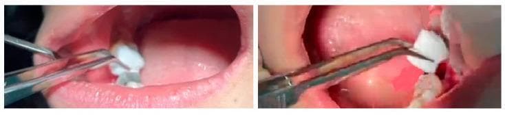 This clinical intraoral photograph series demonstrates the application of a hemostatic gelatin sponge during a dental surgical procedure. The images depict the oral cavity of a patient post-tooth extraction. A sterile, white, irregularly shaped absorbent sponge is being manipulated using silver-colored surgical dressing forceps. The forceps are shown precisely positioning the sponge into the alveolar socket of an extracted tooth. Surrounding anatomical structures include the pink gingival mucosa, the inner buccal mucosa, and adjacent dentition. The procedure illustrates the management of post-extraction sockets to promote hemostasis and clot stabilization using topical hemostatic agents. This visual serves as an educational example of minor oral surgery techniques, specifically focusing on surgical dressing placement for wound care and hemorrhage control in a clinical dentistry setting.