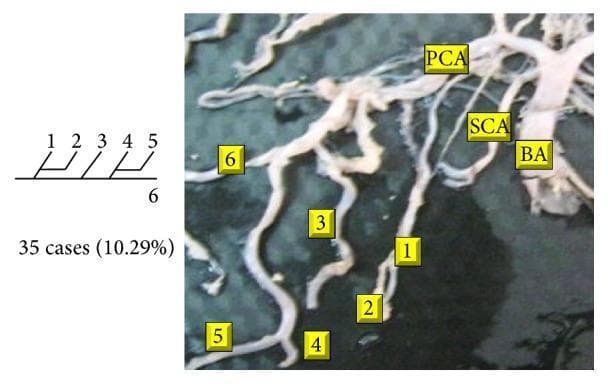 This composite educational image illustrates a Type 13 branching pattern of the posterior cerebral artery (PCA), a morphological variation of the Circle of Willis. The figure consists of a cadaveric clinical photograph of the vertebrobasilar system and a corresponding schematic diagram. In the photograph, key arterial structures are labeled: the basilar artery (BA) serves as the primary trunk, giving rise to the superior cerebellar artery (SCA) and the PCA more superiorly. The distal segment of the PCA, labeled as vessel '6', is shown giving rise to five distinct cortical branches (labeled 1-5). The accompanying schematic diagram provides a simplified representation of this specific architectural arrangement, where a main vessel (6) produces five successive branches. This visual aid is intended for advanced neuroanatomical education, specifically focusing on vascular variations and surgical anatomy of the posterior circulation. Textual data indicates this specific branching pattern was observed in 10.29% (35 cases) of the study specimens.