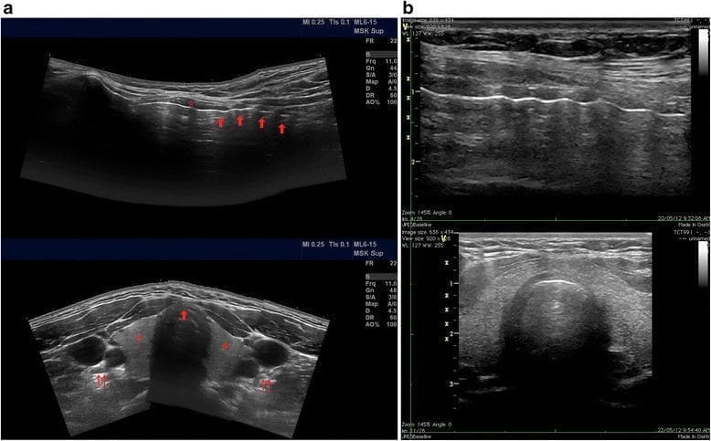 This composite of four B-mode ultrasound images demonstrates the sonographic anatomy of the anterior neck, essential for percutaneous tracheostomy. Panel (a) contains panoramic views: the longitudinal view (top) shows the cricoid cartilage (asterisk) as a superior hyperechoic structure, followed by a series of undulating hyperechoic tracheal rings (arrows) with posterior acoustic shadowing due to luminal air. The transverse view (bottom) displays the isthmus and lobes of the thyroid gland (asterisks), the anterior tracheal cartilage (single arrow), and lateral vascular bundles containing the carotid arteries and internal jugular veins (double arrows). Panel (b) provides standard bedside views: the longitudinal view (top) highlights the linear hyperechoic reflections of the tracheal rings against a dark acoustic shadow, and the transverse view (bottom) emphasizes the curved hyperechoic anterior tracheal wall. This imaging facilitates the identification of the tracheal midline and the avoidance of aberrant vasculature during procedural access between the first and fourth tracheal rings.