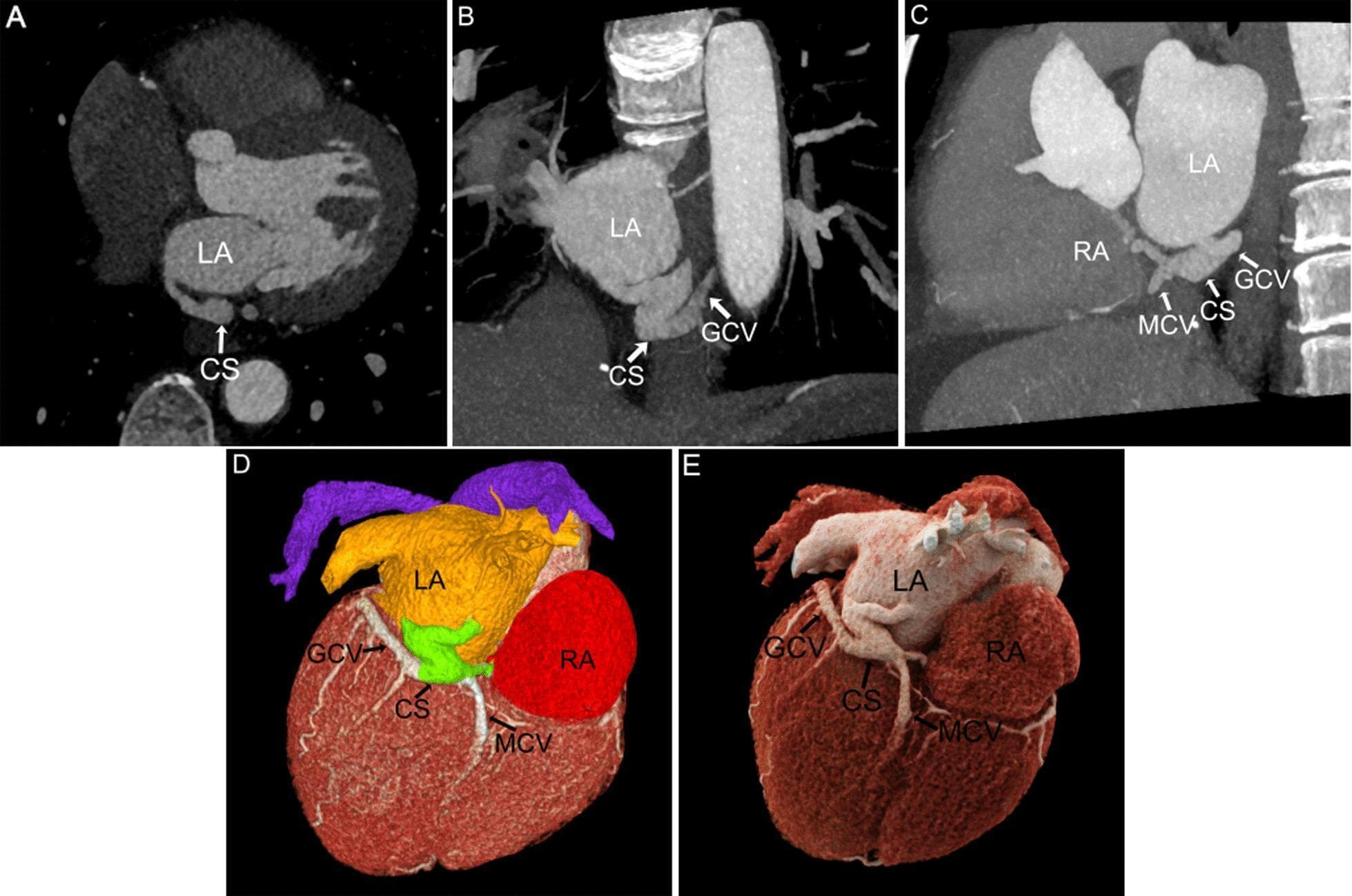 This composite diagnostic image demonstrates Cardiac Computed Tomography (CCT) reconstructions of a Type V Unroofed Coronary Sinus (UCSS). The figure displays five distinct post-processing modalities: (A) Multiplanar Reconstruction (MPR) axial view showing the coronary sinus (CS) inferior to the left atrium (LA); (B, C) Maximum Intensity Projection (MIP) views illustrating a 'Z'-shaped vascular communication between the LA and CS, and the convergence of the CS into the right atrium (RA). These images also detail the positioning of the great cardiac vein (GCV) and middle cardiac vein (MCV). (D, E) Volume Rendering (VR) and Cinematic Rendering (CR) provide 3D spatial context. Panel D utilizes color-coding (Yellow: LA, Red: RA, Green: CS) to differentiate cardiac chambers and the venous system, while Panel E offers high-fidelity realistic rendering of the heart's posterior surface. This image serves to educate on the utility of CCT post-processing for diagnosing complex congenital venous anomalies and understanding the three-dimensional relationship between the coronary sinus and the atrial chambers.