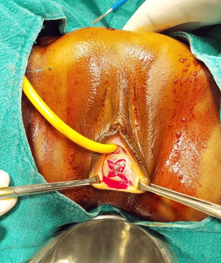This clinical photograph captures a surgical procedure for an imperforate hymen. The image focus is on the perineal area, where a cruciate incision (X-shaped) has been made on the bulging hymen. Two surgical retractors are positioned to hold the vaginal introitus open, revealing the incision site marked by fresh blood and the underlying vaginal vault. A yellow urinary catheter is inserted into the urethra superior to the hymenal membrane to maintain patency and provide drainage during the procedure. The surrounding labial and perineal tissues appear edematous and erythematous, consistent with the obstructive symptoms of hematocolpometra. The patient is draped in a sterile green surgical field, and a metal basin is visible at the inferior aspect of the frame to catch drained fluid. This image illustrates the standard surgical approach (hymenectomy via cruciate incision) used to resolve hematocolpos and associated acute urinary retention in patients with imperforate hymen.