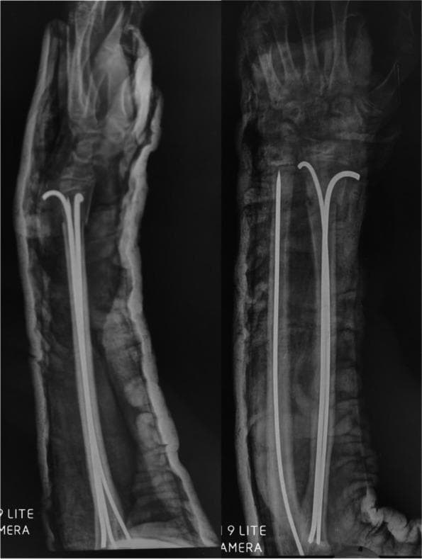 Anteroposterior (AP) and lateral X-ray views of a human forearm showing immediate postoperative results of a pediatric distal forearm fracture reduction. The diagnostic imaging demonstrates internal fixation using multiple intramedullary Kirschner wires (K-wires). In the radius, two pre-bent K-wires are visible, extending through the medullary canal from the distal to the proximal region. A single straight K-wire is positioned within the medullary canal of the ulna. The alignment of both the radius and ulna shows successful surgical reduction with restored anatomical continuity. An external sugar-tong splint or plaster cast is visible as a radio-opaque layer surrounding the soft tissue of the forearm. The clinical focus of this image is to illustrate the surgical technique for stabilizing pediatric long bone fractures using a minimally invasive intramedullary pinning approach, ensuring maintenance of reduction while allowing for secondary bone healing.