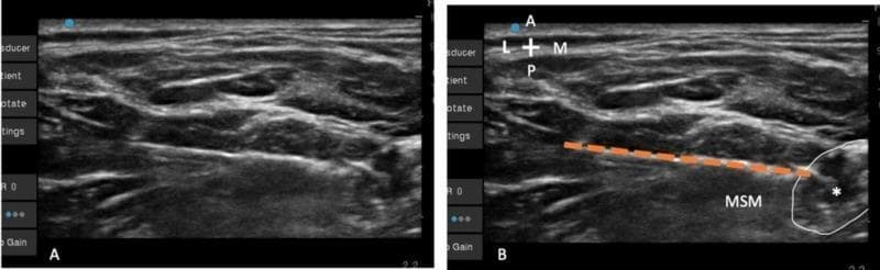This diagnostic ultrasound image demonstrates an interscalene brachial plexus block procedure. The visual is divided into two panels: (A) an unlabeled sonogram and (B) an annotated version showing a lateral-to-medial in-plane needle approach. Anatomical landmarks include the middle scalene muscle (MSM), which appears as a relatively hypoechoic structure with a striated fibrillar texture, and the upper trunk of the brachial plexus, marked by an asterisk (*) and outlined by a white circle. A Tuohy needle path is represented by an interrupted orange line, illustrating its trajectory through the MSM to reach the lateral aspect of the upper trunk. The imaging displays the relationship between the deep cervical fascia and the neural structures, highlighting the needle's positioning for regional anesthesia. This clinical image is intended for medical education regarding ultrasound-guided nerve blocks and regional anesthetic techniques, specifically focusing on needle visualization and anatomical target identification in the cervical region.