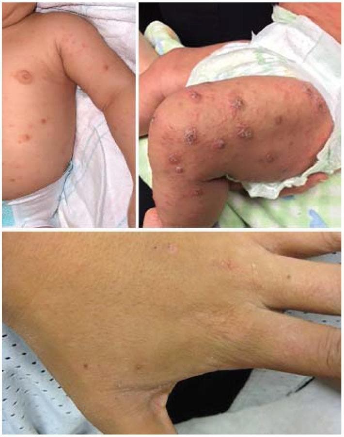 A composite of three clinical photographs demonstrating the dermatological manifestations of scabies in an infant and an adult. The top-left panel shows an infant's trunk and arm with scattered, erythematous papules. The top-right panel displays the infant's lower extremity, showing a higher density of larger, inflammatory papulovesicles and nodules on the thigh and leg, some of which appear crusted or excoriated, which is a common presentation in infantile scabies. The bottom panel provides a close-up of an adult hand, focusing on the dorsal surface and finger webs. This view reveals small, discrete erythematous papules and subtle, linear, thread-like structures consistent with Sarcoptes scabiei burrows. The skin also shows signs of generalized xerosis. Collectively, these images illustrate the age-dependent distribution and morphology of scabies, highlighting the more inflammatory, nodular response in infants versus the classic acral distribution and burrowing seen in adults.