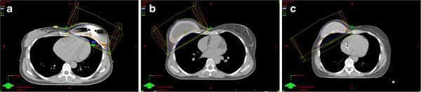 This set of axial computerized tomography (CT) scans illustrates radiotherapy (RT) planning in patients following immediate breast reconstruction (IBR) with three distinct types of implants. The images demonstrate the anatomical relationship between the thoracic cage, heart, lungs, and the reconstructed breast. In panel (a), a Type I temporary tissue expander is shown, featuring a metallic artifacts from an integrated magnetic port used for postoperative expansion. Panel (b) depicts a Type II expandable implant, appearing larger and more irregular, designed for one-stage reconstruction with outer silicone gel and inner saline chambers. Panel (c) shows a Type III permanent silicone gel implant with a uniform density and predefined volume. Superimposed on each CT slice are colored isodose lines and wireframe geometric projections representing radiation beam tangents. These overlays illustrate how different implant morphologies and materials (e.g., metal in magnets versus silicone) influence the planning target volume (PTV) and dose distribution across the chest wall during post-mastectomy radiotherapy (PMRT).