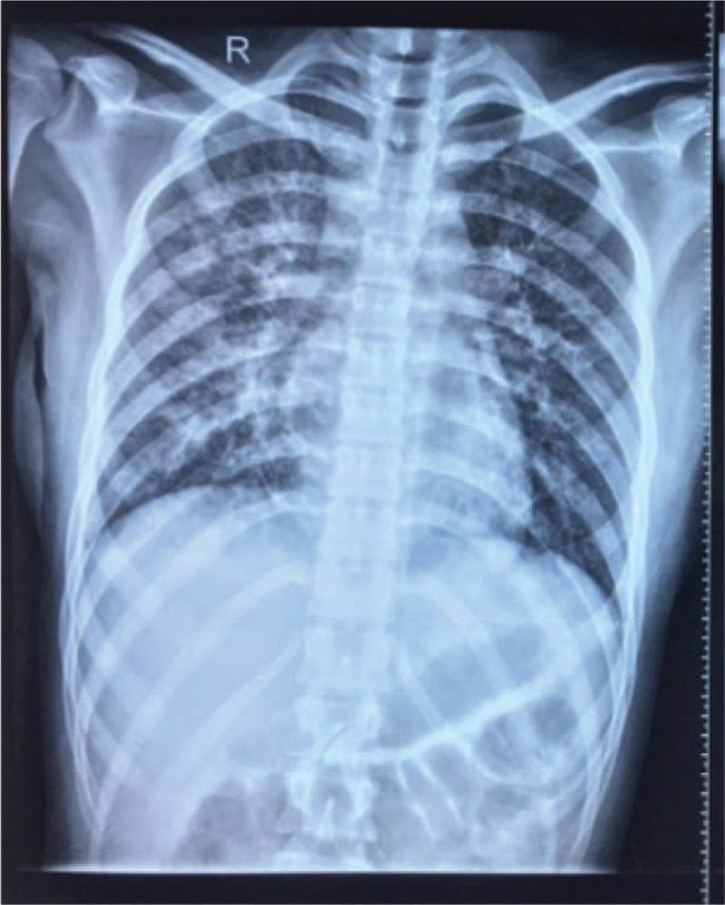 This diagnostic image is a posterior-anterior (PA) chest X-ray of a 22-year-old female patient, demonstrating significant bilateral pulmonary pathology. The lung fields exhibit diffuse, patchy, and reticulonodular infiltrates that are symmetrically distributed throughout the upper, middle, and lower zones. These increased opacities obscure the fine details of the pulmonary vasculature and indicate extensive alveolar or interstitial involvement. The hila appear somewhat prominent, likely due to the surrounding parenchymal density. The mediastinal contour, heart size, and diaphragmatic outlines are visible but partially blurred by the overlying lung disease. There is no clear evidence of significant pleural effusion or pneumothorax on this view. In a clinical context involving rapid onset dyspnea, fever, and peripheral eosinophilia, these radiographic findings are consistent with acute eosinophilic pneumonia (AEP) or severe community-acquired pneumonia. The image serves as an educational example of diffuse lung disease and the characteristic radiographic presentation of inflammatory pulmonary eosinophilic syndromes.