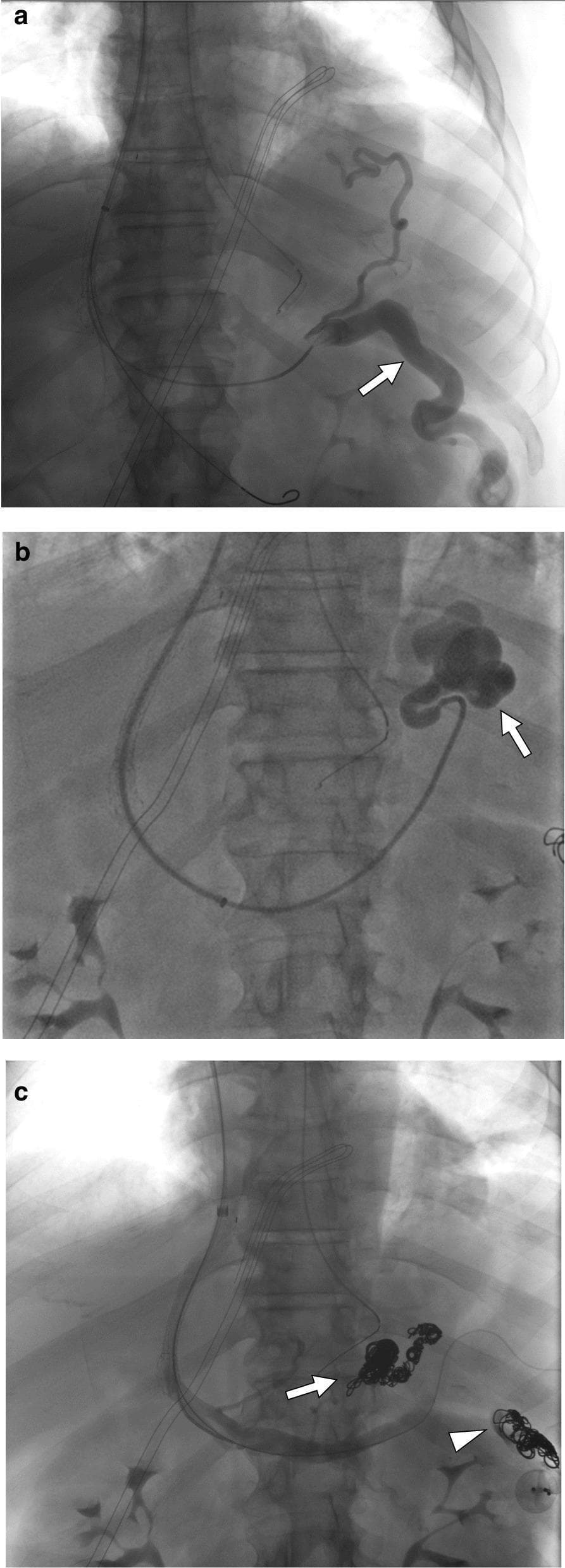 This set of three fluoroscopic angiograms (a, b, and c) documents the interventional management of portal hypertension complications in a patient with cirrhosis. Image (a) is a post-TIPS (Transjugular Intrahepatic Portosystemic Shunt) angiogram demonstrating a dilated, tortuous left testicular vein (arrow) originating from the splenic vein, contributing to a clinically significant varicocele. Image (b) shows contrast enhancement of large, bulbous gastric varices (arrow) as a manifestation of portosystemic collateralization. Image (c) displays the result of therapeutic embolization; radiopaque embolic coils are clearly visible within the gastric varices (arrow) and the varicocele (arrowhead). The absence of contrast filling in these areas in the final angiogram indicates successful vascular occlusion. This sequence illustrates the use of TIPS and subsequent targeted embolization to manage symptomatic varices and ectopic venous congestion associated with portal hypertension. Educational concepts include vascular anatomy, complications of cirrhosis, and the radiographic appearance of embolic materials.