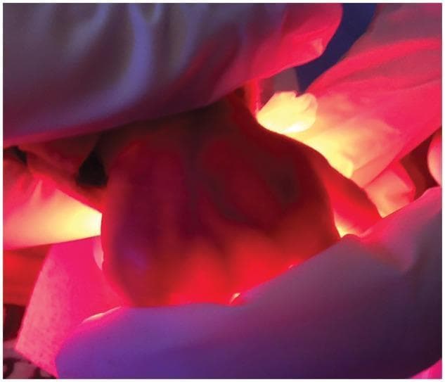 This clinical photograph demonstrates the technique of transillumination on a neonatal hand within a Neonatal Intensive Care Unit (NICU) setting. A red LED light source is applied to the dorsal or palmar surface, causing the translucent tissues of the infant's hand to glow with a vivid red hue. This high-contrast illumination significantly enhances the visualization of deep anatomical structures, specifically the superficial venous network, which appears as dark, linear shadows against the bright background. The hand is being stabilized by a healthcare provider wearing sterile clinical gloves, reflecting infection control protocols during the procedure. This visual illustrates a low-cost diagnostic or procedural aid used to facilitate peripheral intravenous access (cannulation) or arterial sampling in neonates by improving vein localization. The background shows blurred clinical equipment, consistent with an incubator environment. The image serves as an educational example of how specific light wavelengths can be utilized to improve visibility of vascular anatomy in small pediatric patients.
