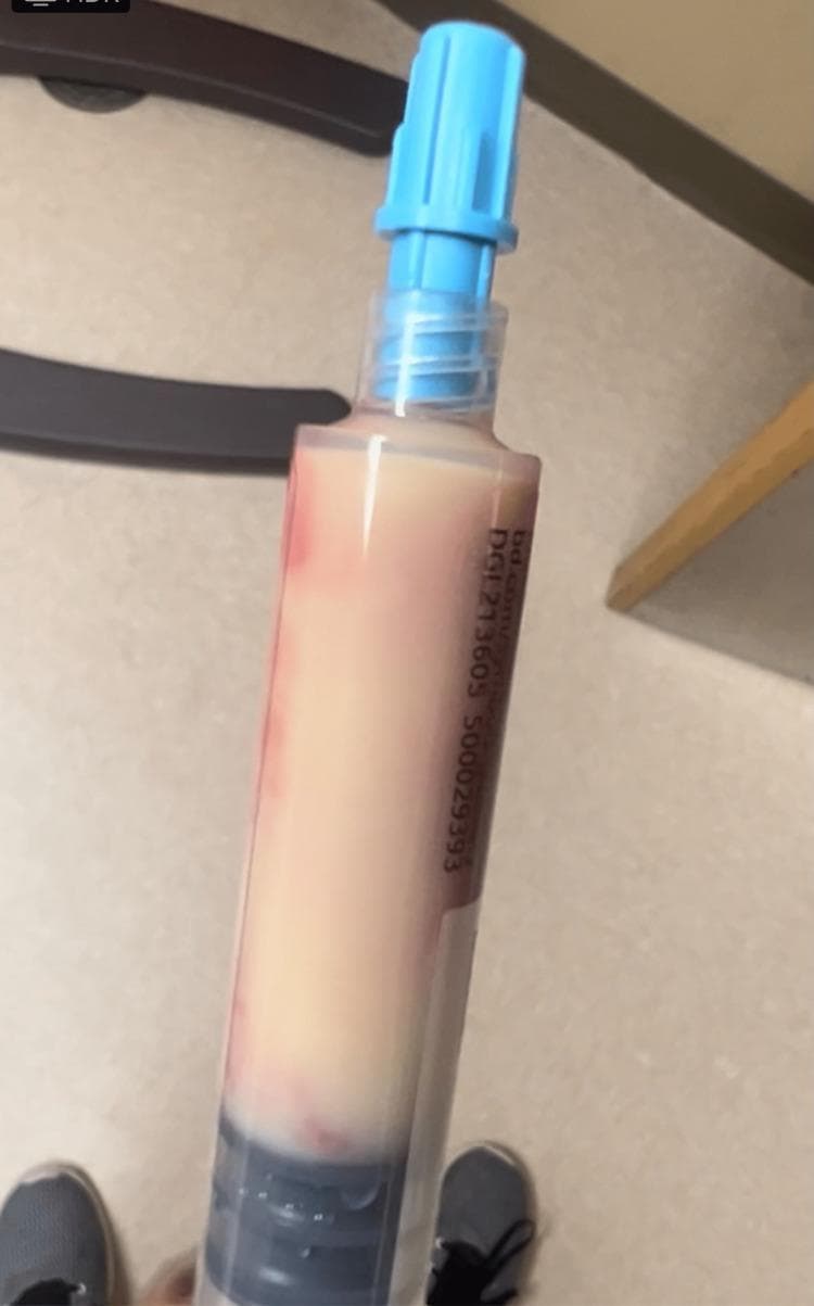 A clinical photograph of a lipemic blood sample contained within a clear plastic blood collection tube with a light blue stopper. The specimen exhibits extreme turbidity, appearing thick, opaque, and milky-white to creamy in color, characteristic of severe hypertriglyceridemia (triglycerides >4000 mg/dl in this clinical context). There is a visible separation of components: a dense, darker reddish-brown clotted layer at the bottom, and a predominant supernatant layer with a 'tomato soup' or 'creamy' appearance containing faint reddish streaks. This visual finding is a classic diagnostic sign of lactescent serum/plasma, often associated with acute pancreatitis and metabolic disorders. The tube is a standard Vacutainer labeled with alphanumeric manufacturing codes.