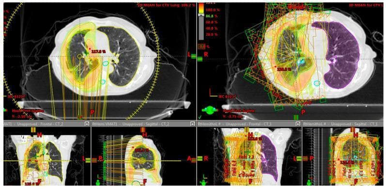 This diagnostic comparison illustrates radiotherapy dose distribution planning for lung cancer, comparing Volumetric Modulated Arc Therapy (VMAT) on the left with Intensity-Modulated Radiation Therapy (IMRT) step-and-shoot planning on the right. The visualization includes axial (top), coronal (bottom left), and sagittal (bottom right) views superimposed on Computed Tomography (CT) scans of the thorax. The VMAT plan demonstrates a more conformal, continuous dose distribution, characterized by smooth orange and yellow isodose curves that wrap around the target pulmonary region with a circular gantry path indicated by yellow markings. In contrast, the IMRT plan shows a more fragmented and angular dose distribution, featuring multiple static beam paths (represented by green rectangles and orange lines) intersecting the chest. A color-coded dose-volume histogram scale is visible, where warmer colors (orange/yellow) represent high-dose regions and cooler colors (green/purple) represent lower-dose spread. The comparison highlights VMAT's superior ability to achieve high dose conformity to the target while potentially sparing more internal lung tissue and surrounding organs at risk compared to the IMRT technique.