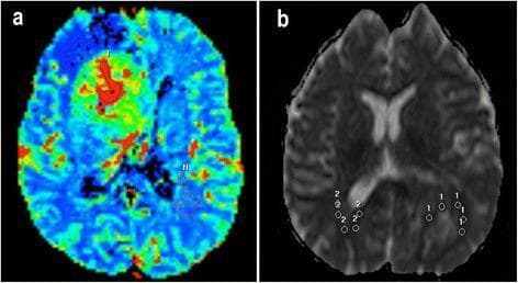 This diagnostic imaging composite illustrates the radiological assessment of a high-grade glioblastoma using advanced MRI sequences. Panel (a) presents a Perfusion-Weighted Imaging (PWI) parametric map for calculating the relative Cerebral Blood Volume (rCBV) ratio. The pseudocolor map shows a hyperperfused mass in the right frontal region, with a red/orange core (ROI labeled 'T') indicating high cerebral blood volume, compared to the contralateral healthy white matter (ROI labeled 'N') shown in blue. Panel (b) displays a Diffusion-Weighted Imaging (DWI) Apparent Diffusion Coefficient (ADC) map for calculating the relative ADC (rADC) ratio. Multiple circular regions of interest (ROIs) are placed within the solid tumor area (labeled '1') and the contralateral healthy cerebral parenchyma (labeled '2'). The visual comparison highlights tumor-related changes in perfusion and diffusion, which are critical for grading primary brain tumors, identifying neovascularization, and differentiating solid tumor from necrosis or edema.