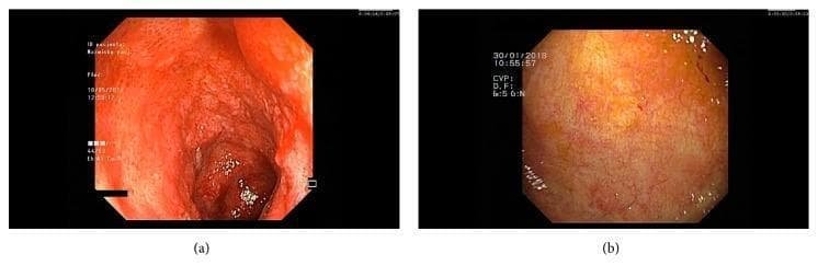 This comparison chart features two endoscopic images of the ileal mucosa, illustrating the visual progression of inflammatory bowel disease (IBD) treatment. Image (a) depicts the initial ileoscopy, showing severe mucosal inflammation characterized by intense erythema, edema, and a friable texture. Spontaneous bleeding and loss of normal vascular patterns are evident, consistent with active pan-enteritis or ulcerative colitis. In contrast, image (b) shows a follow-up ileoscopy after five months of vedolizumab therapy. This image demonstrates significant endoscopic healing, with the mucosa appearing healthy and pale pink with visible, normal vascular architecture and an absence of friability, edema, or spontaneous bleeding. These diagnostic images serve as an educational comparison of active disease versus therapeutic remission in a clinical gastroenterology context, highlighting the efficacy of biologic therapy in restoring mucosal integrity.