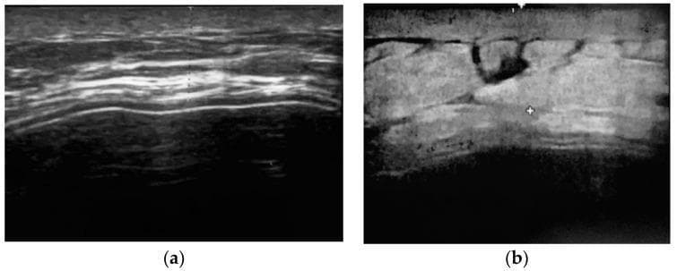 Diagnostic ultrasound (US) images depicting the soft tissue coverage of a tissue expander following two-stage breast reconstruction. Figure (a) illustrates a cross-sectional view of the skin and subcutaneous tissue layers. The image shows a well-defined hyperechoic superficial layer (epidermis/dermis) followed by deeper layers of varying echogenicity representing the subcutaneous fat and musculofascial planes. Figure (b) demonstrates the total thickness of the implant coverage, involving a musculofascial pocket composed of the pectoralis major and serratus anterior fascia. The coverage appears as a heterogeneous band of tissue with mixed echogenicity. Visible within the tissue are hypoechoic to anechoic areas, which may represent small fluid collections or variations in tissue density. Electronic calipers (markers) are visible for quantitative measurement of the coverage thickness. This imaging is used clinically to assess the integrity and thickness of the soft tissue envelope surrounding prosthetic implants to evaluate for potential complications like thinning, seroma, or implant exposure.